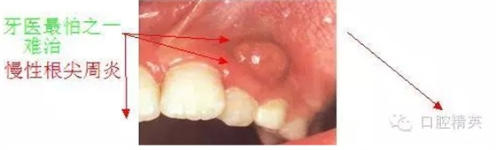 慢性根尖周炎的臨床合理治療