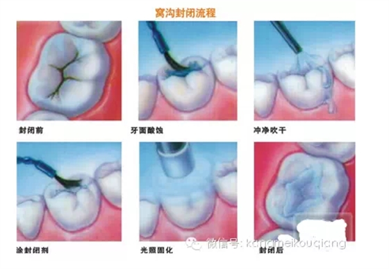 口腔窩溝封閉，就如同給牙齒穿上了一層保護(hù)衣，使牙齒免受食物侵蝕。原理：窩溝封閉后，窩溝內(nèi)原有的細(xì)菌斷。