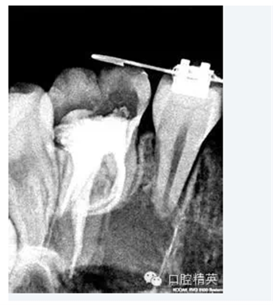 彎曲根管預(yù)備的方法和技巧