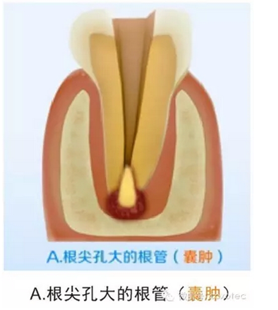 讓你知道根管測量受影響的原因