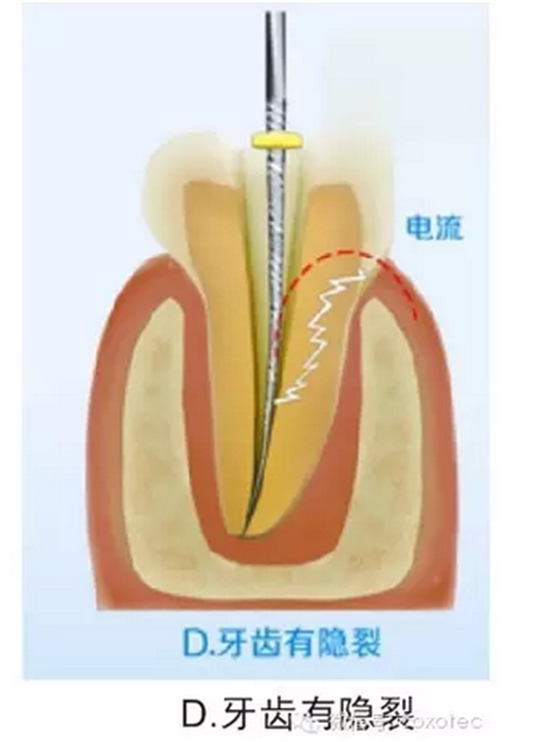 讓你知道根管測量受影響的原因