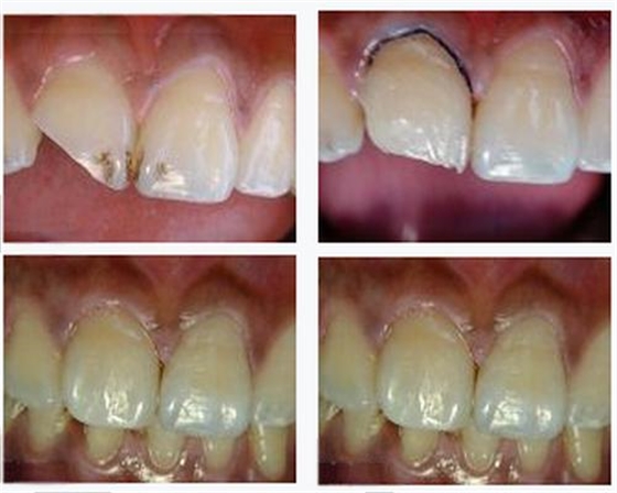各類(lèi)牙洞型樹(shù)脂修復(fù)