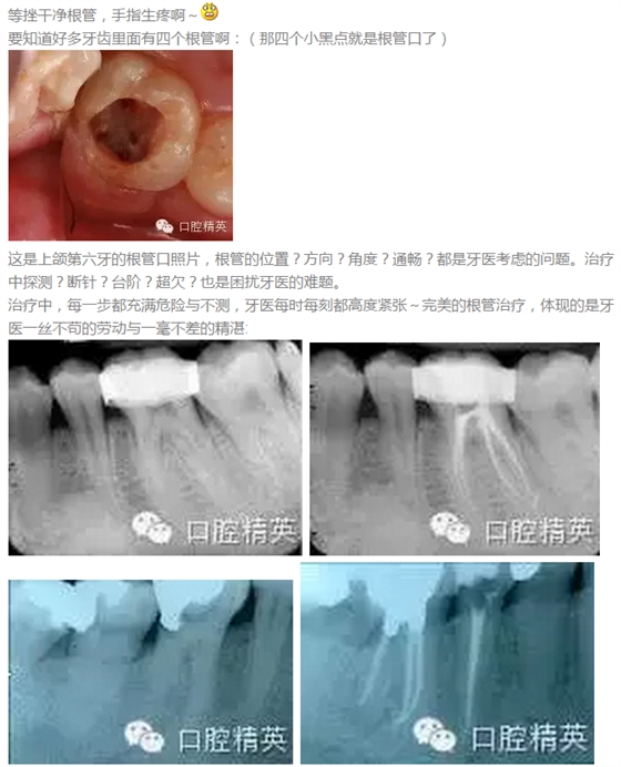 根管治療