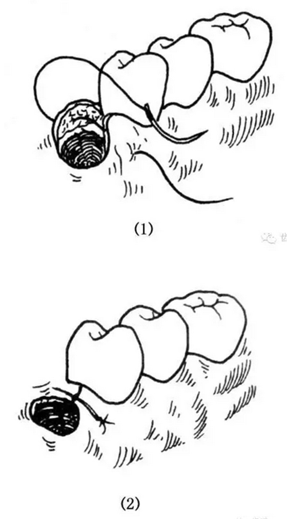 牙醫(yī)基本技能：口內(nèi)縫合術(shù)（文字、示意圖及視頻）