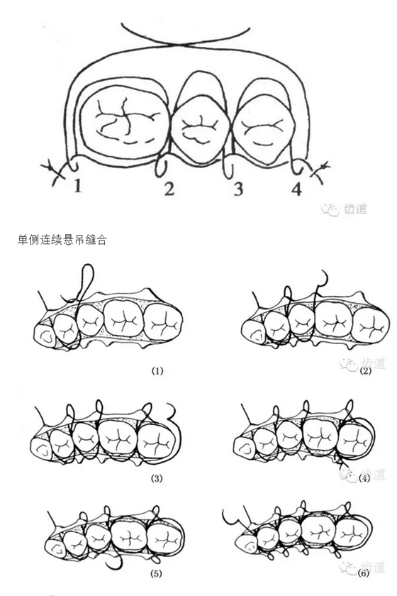 牙醫(yī)基本技能：口內(nèi)縫合術(shù)（文字、示意圖及視頻）