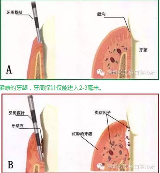 刷牙出血，牙齦紅腫，并非缺乏維生素