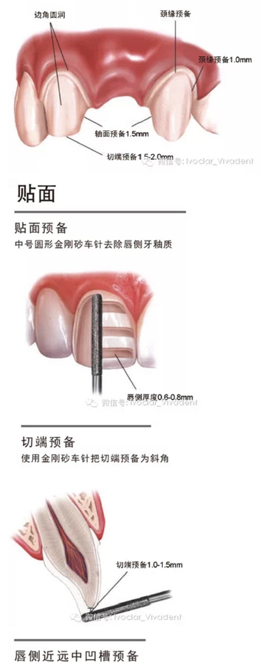 時常搞不清楚怎么備牙嗎？義獲嘉教您如何完美備牙