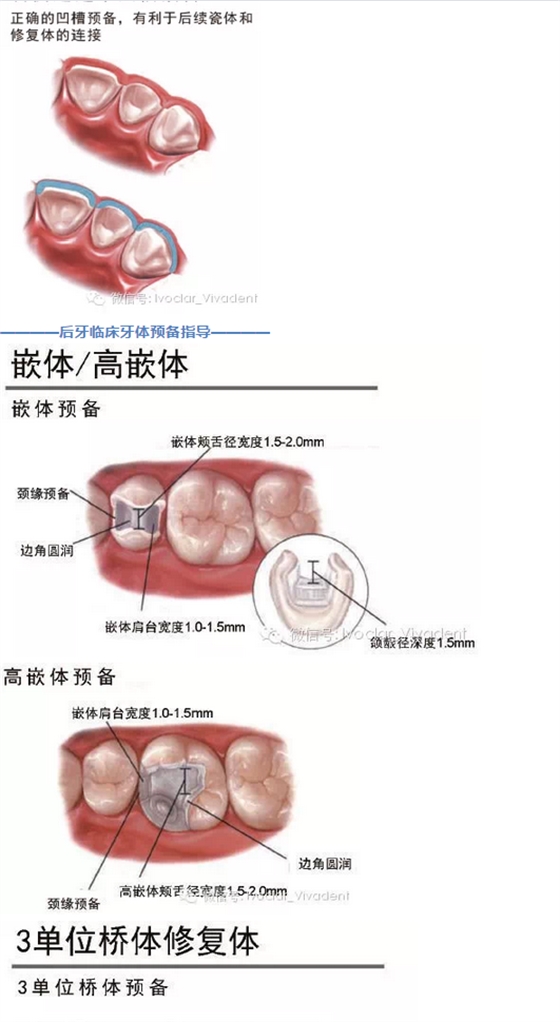 時常搞不清楚怎么備牙嗎？義獲嘉教您如何完美備牙