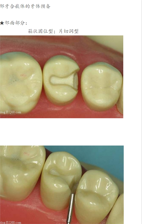 嵌體牙體預(yù)備方法