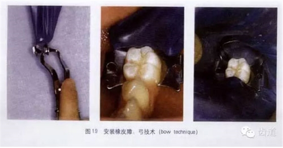 橡皮障的臨床運(yùn)用大全