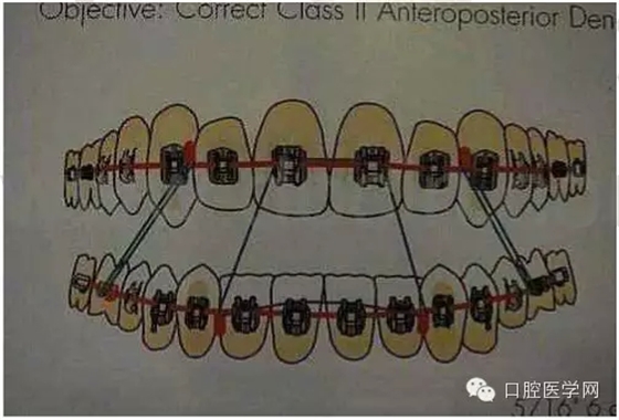 正畸damon system橡皮筋(elastics)掛法示意圖