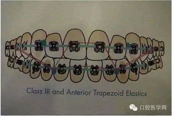 正畸damon system橡皮筋(elastics)掛法示意圖