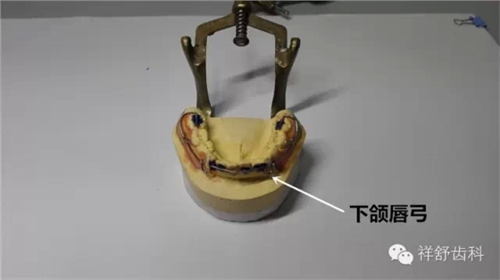 圖解Frankel-Ⅲ功能矯治器制作步驟