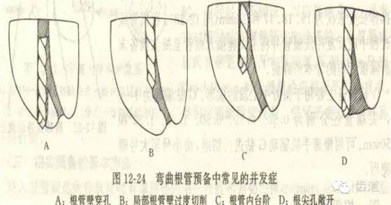 根管治療的并發(fā)癥及處理