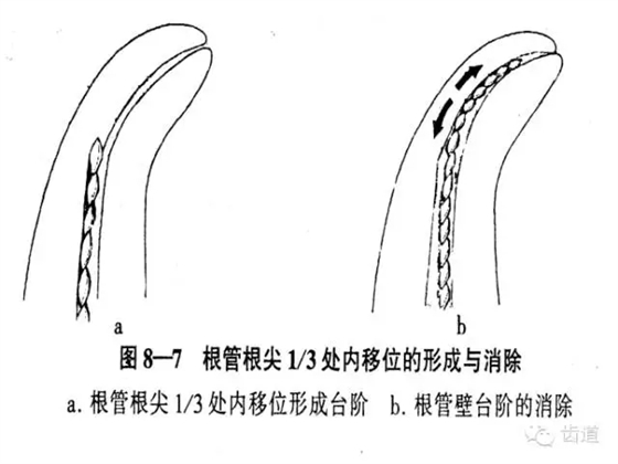 根管治療的并發(fā)癥及處理