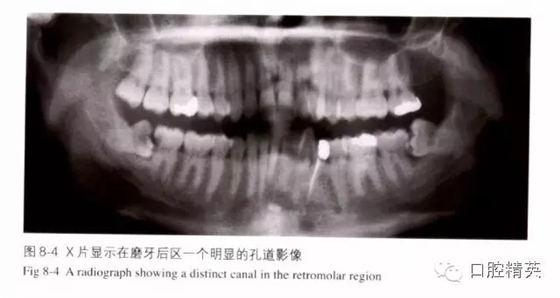 分析局部麻醉失敗的常見原因