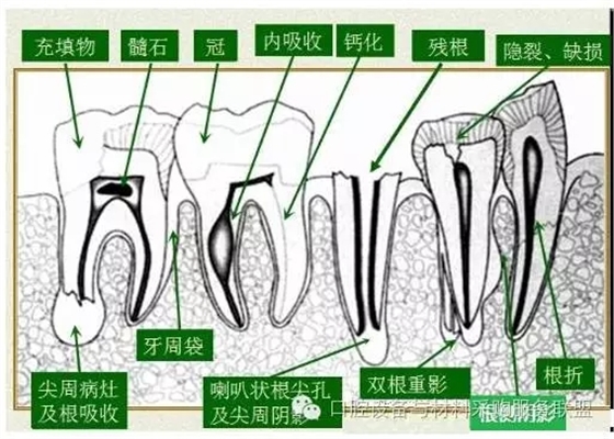 超實用的根管口的探查術(shù)