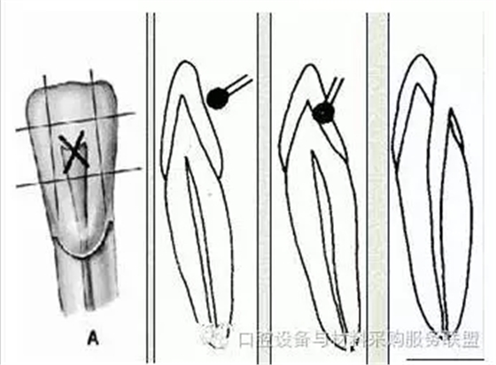 超實用的根管口的探查術(shù)