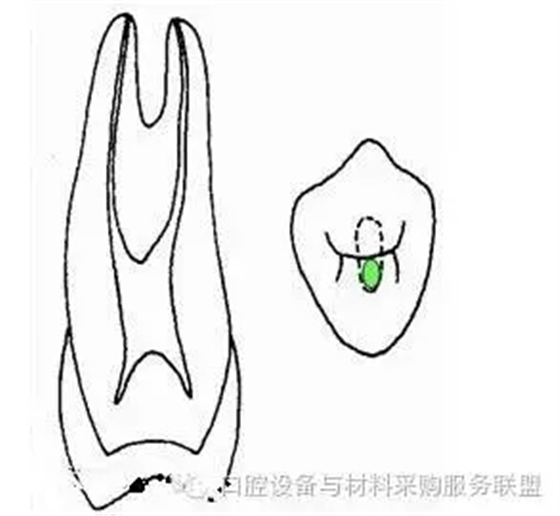 超實用的根管口的探查術(shù)