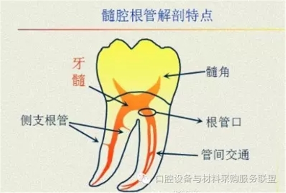 超實用的根管口的探查術(shù)