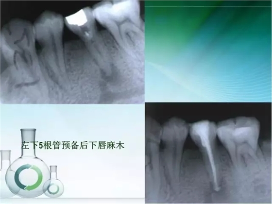 根管治療并發(fā)癥及處理