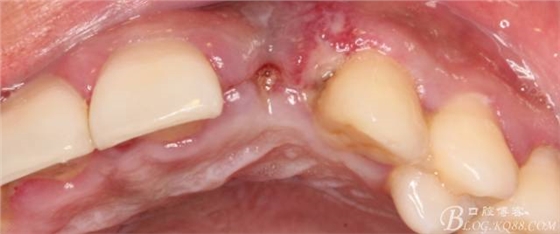 【征文大賽】一例上前牙種植失敗病例的補(bǔ)救--梁光強(qiáng)