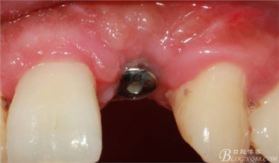 【征文大賽】一例上前牙種植失敗病例的補(bǔ)救--梁光強(qiáng)