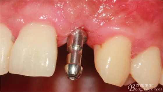 【征文大賽】一例上前牙種植失敗病例的補(bǔ)救--梁光強(qiáng)