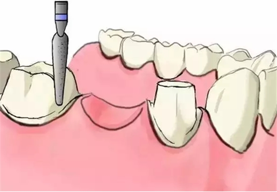 圖解：種牙與鑲牙的區(qū)別，缺牙的趕緊看.png