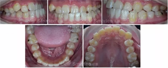 【病例展示】Smartee隱形正畸中國(guó)好病例鑒賞第三波
