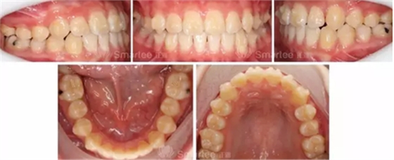 【病例展示】Smartee隱形正畸中國(guó)好病例鑒賞第三波
