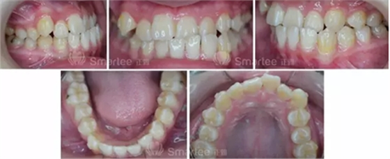 【病例展示】Smartee隱形正畸中國(guó)好病例鑒賞第三波