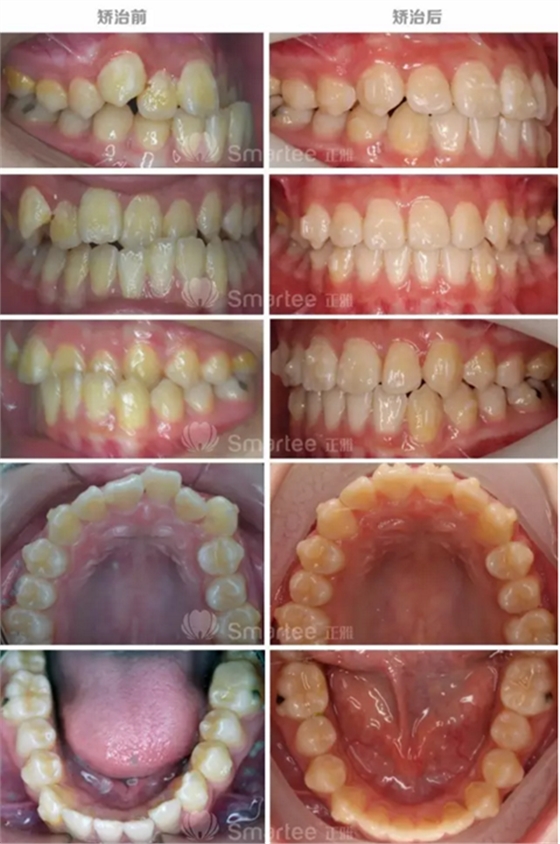 【病例展示】Smartee隱形正畸中國(guó)好病例鑒賞第三波