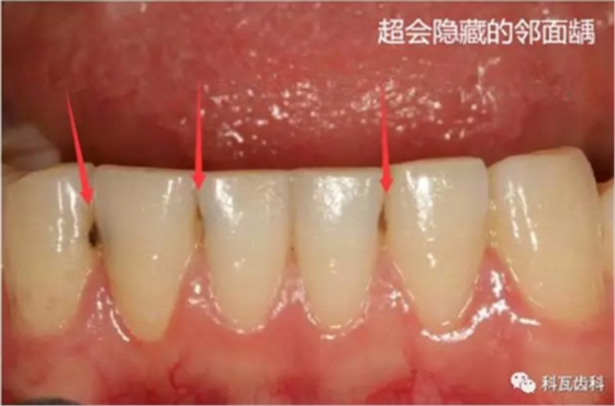 牙縫間的黑線是鄰面齲，還一壞壞倆，巧用它幫你渡過一“劫”