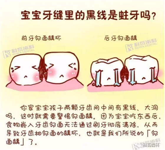 牙縫間的黑線是鄰面齲，還一壞壞倆，巧用它幫你渡過一“劫”