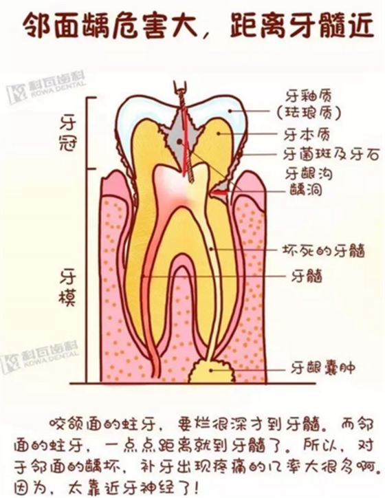 牙縫間的黑線是鄰面齲，還一壞壞倆，巧用它幫你渡過一“劫”