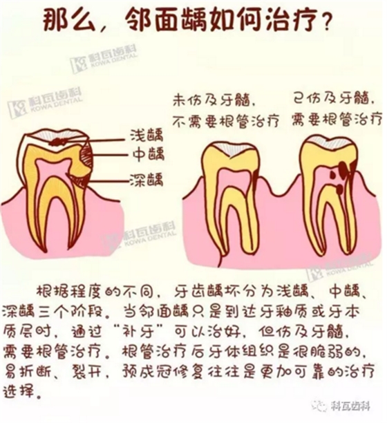 牙縫間的黑線是鄰面齲，還一壞壞倆，巧用它幫你渡過一“劫”