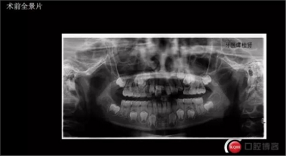 CBCT導(dǎo)航下多生牙拔除，混合牙列期矯正思考！