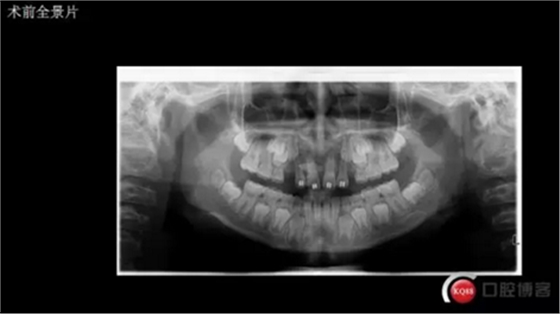 CBCT導(dǎo)航下多生牙拔除，混合牙列期矯正思考！