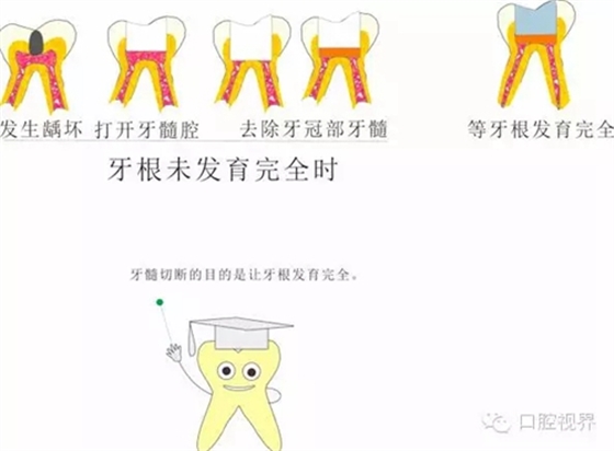 【愛牙科普知識300問】 “什么是活髓切斷術？”