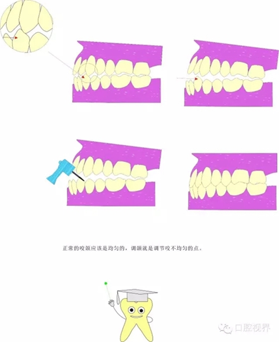 【愛牙科普知識300問】 “什么是牙間牽引？”