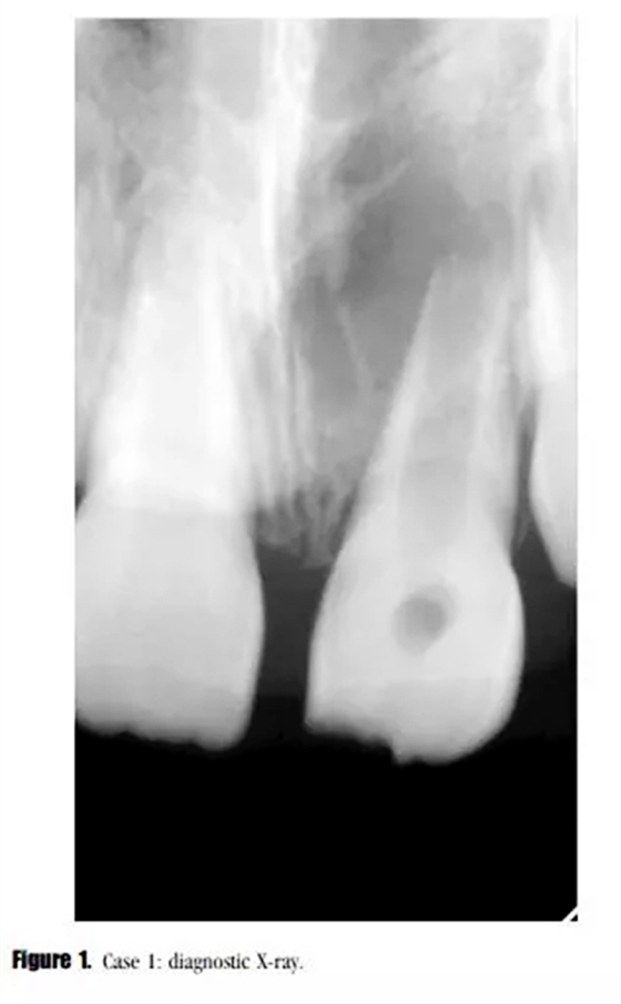 病例分享｜牙髓血管再生治療失敗后的牙根發(fā)育：2例