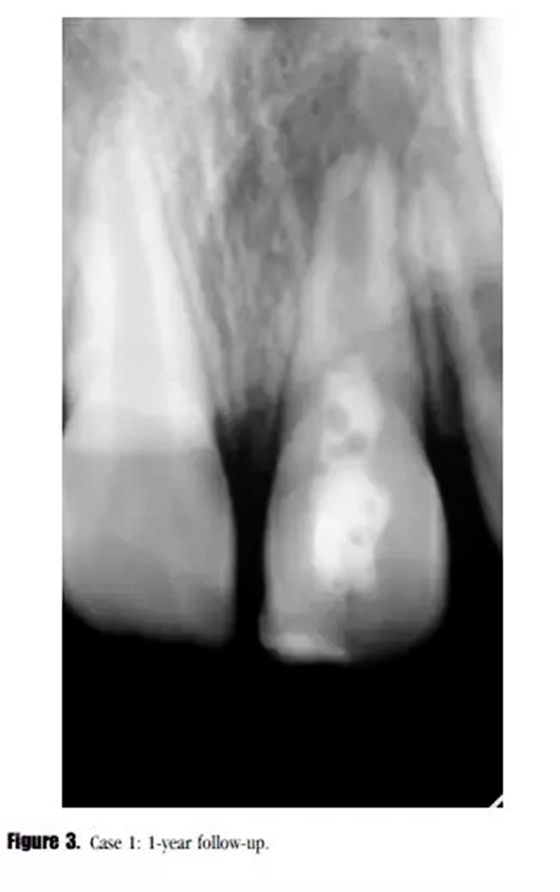 病例分享｜牙髓血管再生治療失敗后的牙根發(fā)育：2例