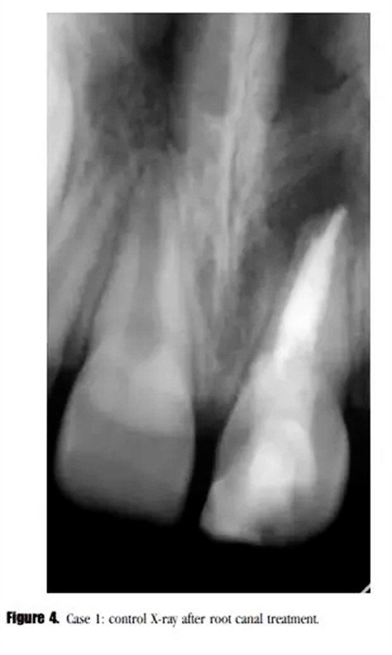 病例分享｜牙髓血管再生治療失敗后的牙根發(fā)育：2例