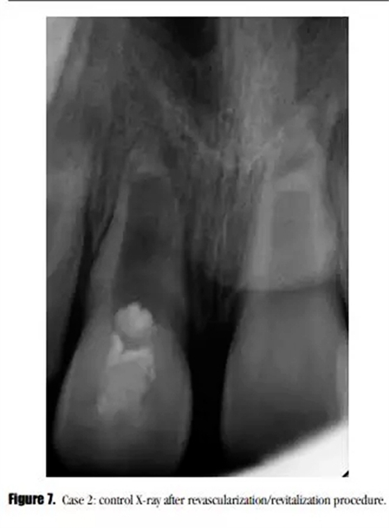 病例分享｜牙髓血管再生治療失敗后的牙根發(fā)育：2例