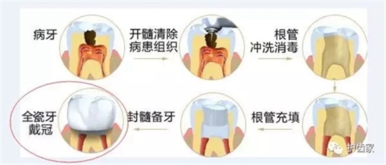 根管治療后，可以不做烤瓷牙嗎？