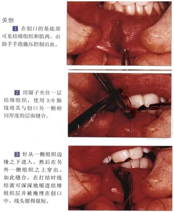 粘液腺囊腫切除術(shù)