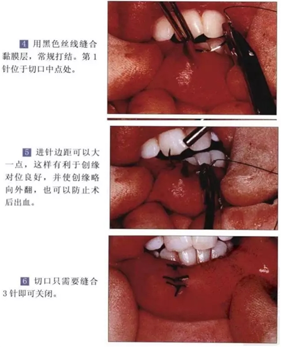 粘液腺囊腫切除術(shù)