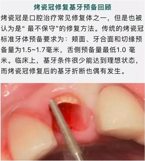 做全冠修復(fù)時基牙根面暴露，如何備牙？