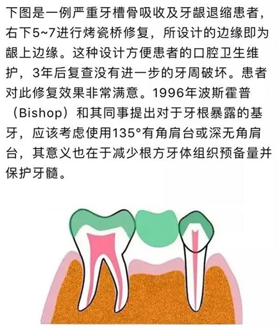 做全冠修復(fù)時基牙根面暴露，如何備牙？